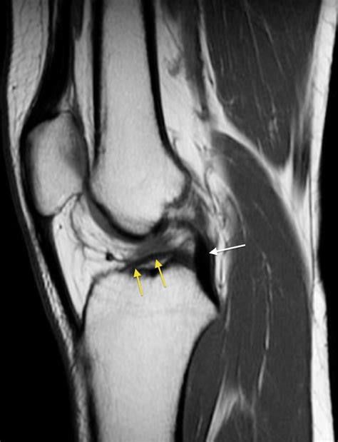 acl tear diagnostic test mri|complete tear of acl mri.